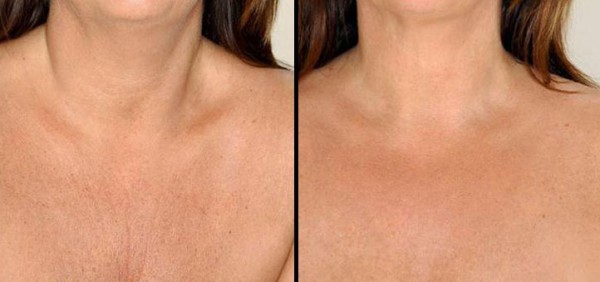 Биоревитализация улучшает кожу